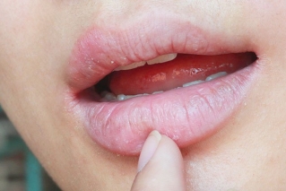 写真：インプラントとドライマウス（口腔乾燥症）の関係