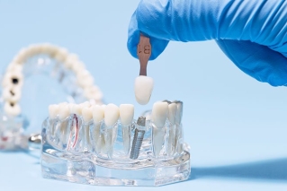 写真：インプラントは噛み合わせ治療？審美治療？目的・違い・治療の順番について詳しく解説