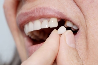 写真：インプラントがうまく接合しない、外れてしまう…そんなお悩みをお持ちの方へ