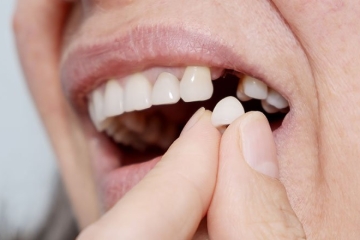 写真：インプラントがうまく接合しない、外れてしまう…そんなお悩みをお持ちの方へ