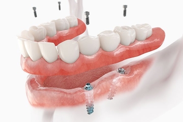 写真：骨の量が足りなくても大丈夫！インプラントの傾斜埋入について