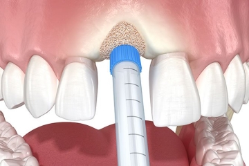写真：骨の減少を予防する『ソケットプリザベーション』とは