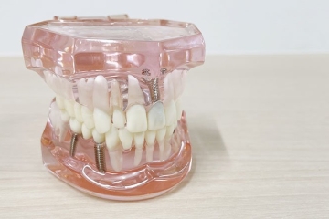 写真：インプラントの噛み合わせはなぜ重要？天然歯との違いと咬合調整が必要な理由