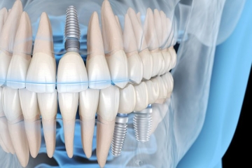 写真：プレシジョンインプラント～患者さん一人ひとりに最適化された精密インプラント治療