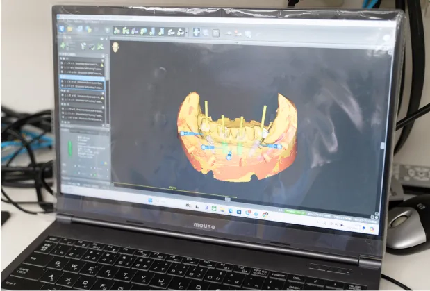 Advanced Implant Techniques