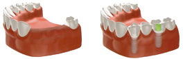 3本の歯を2本のインプラントで支えているイメージ
