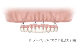 All On 4 オール オン フォー 札幌 インプラントオフィス大通
