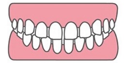 写真：空隙歯列