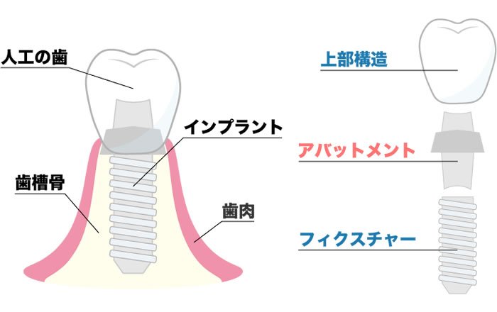 インプラント治療の縁の下の力持ち！アバットメントの重要性とは