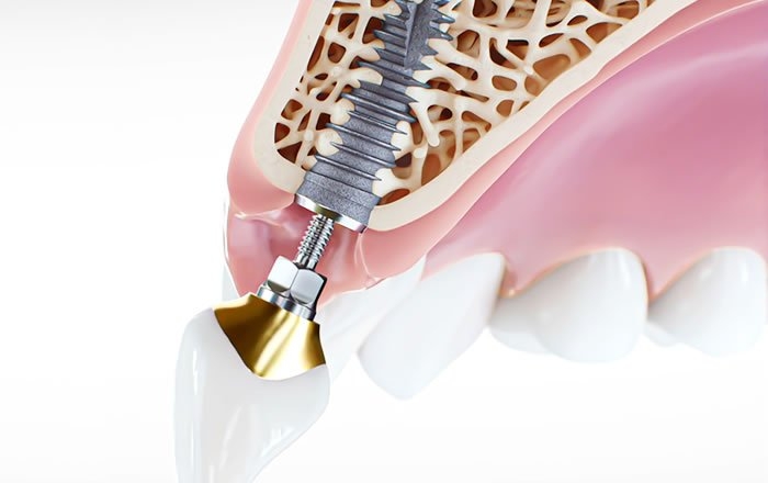 アバットメントの大切な役割：上部構造の向きの補正