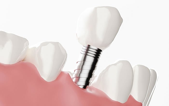 アバットメントのない1ピース型インプラント