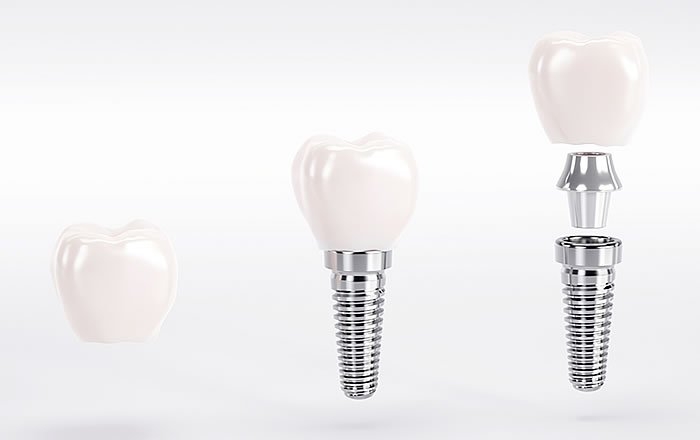 アバットメントの大切な役割：フィクスチャーと上部構造の接続