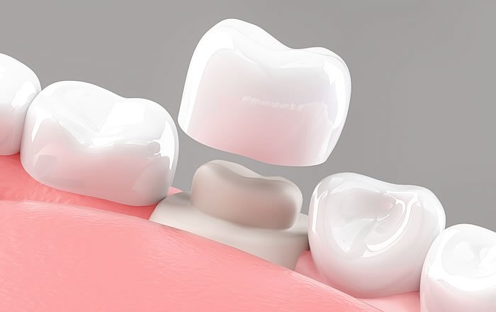 アバットメントの大切な役割：審美性の保持