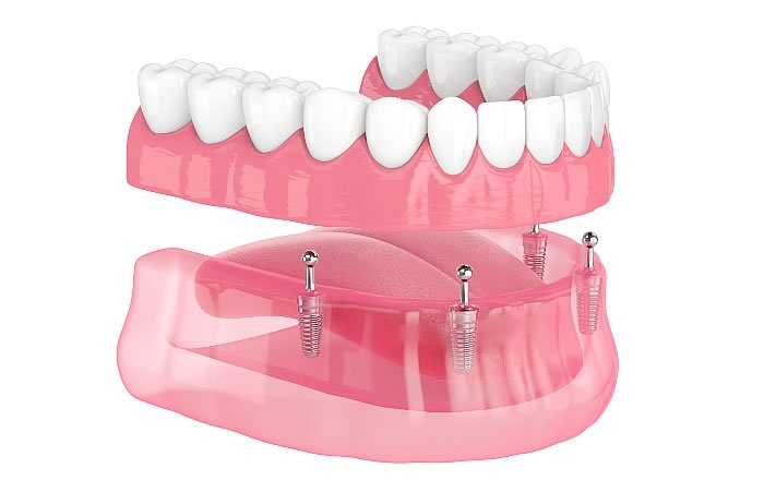 インプラントオーバーデンチャー