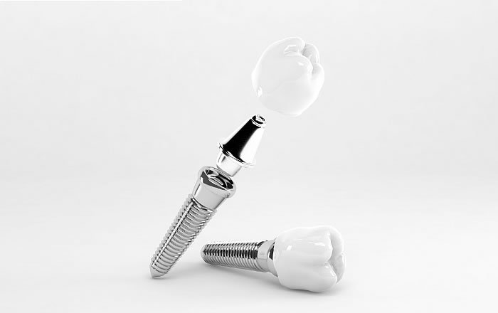 2ピースタイプのインプラント