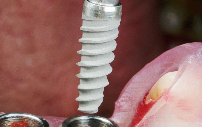 スクリュータイプのインプラント体（人工歯根）