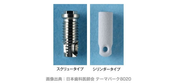 シリンダータイプのインプラント体（人工歯根）