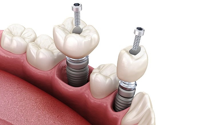 クラウンタイプの上部構造