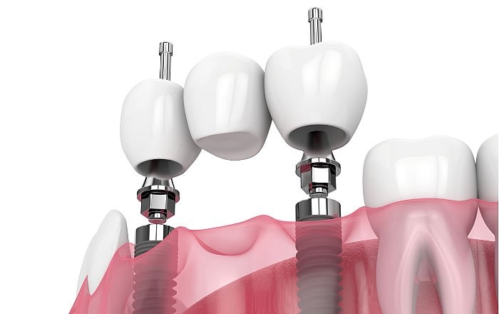 ブリッジタイプの上部構造