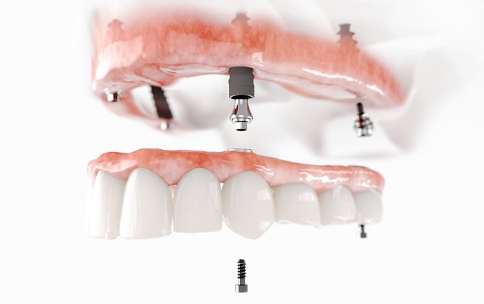 オールオンフォー