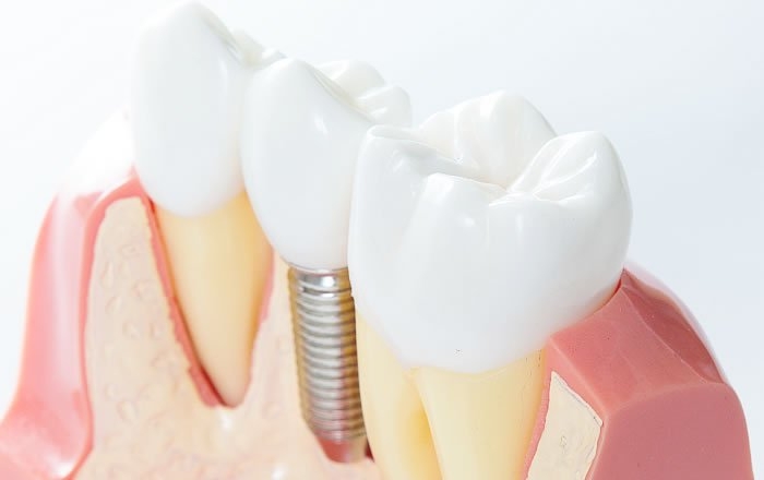 インプラントと言っても種類は様々？構造・形状・上部構造の違いを解説
