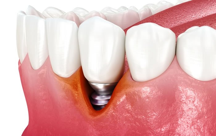 ドライマウス（口腔乾燥症）がインプラントに与える影響：インプラント周囲炎のリスクが高まる