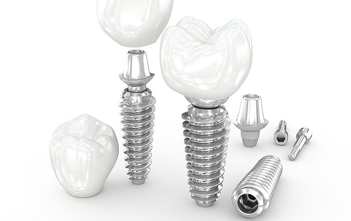 インプラント自体の価格が高額