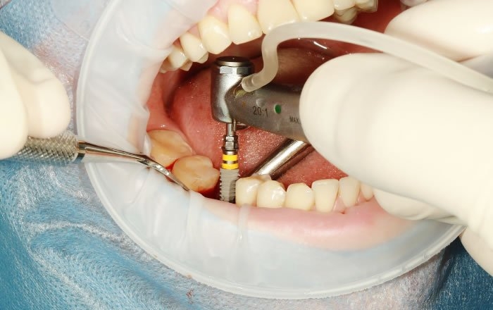 インプラントが抜けた場合の対処法：インプラントを再度埋入する