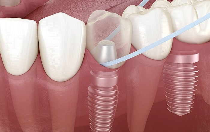 インプラントがグラグラする場合の対処法：アバットメントを締め直す、炎症の除去を行う