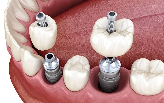 歯ぎしりがインプラントに及ぼす影響：上部構造の脱落