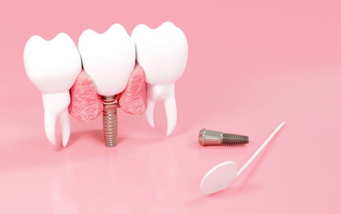 インプラント治療に際し、押さえておくべきポイント：痛みや腫れが出ることについて理解しておく