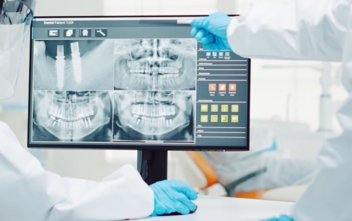 インプラント治療後の痛みや腫れの程度を左右する要因：埋入するインプラントの本数