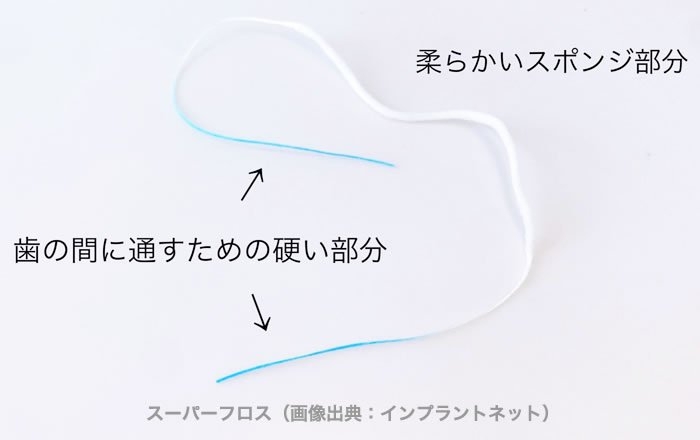 インプラントと歯ぐきの間など清掃が難しい場所には、スーパーフロスがおすすめ