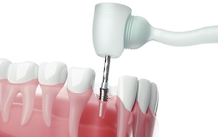 インプラントのデメリット