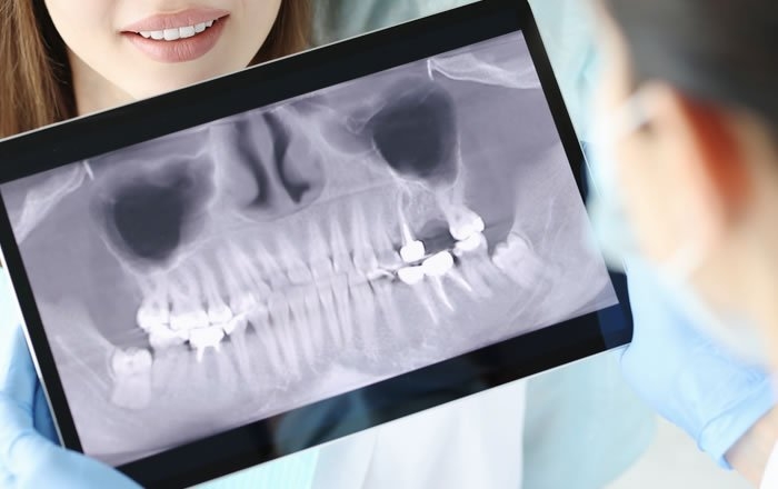 オールオン4(All-on-4®)のメリット:顎の骨の条件が緩い