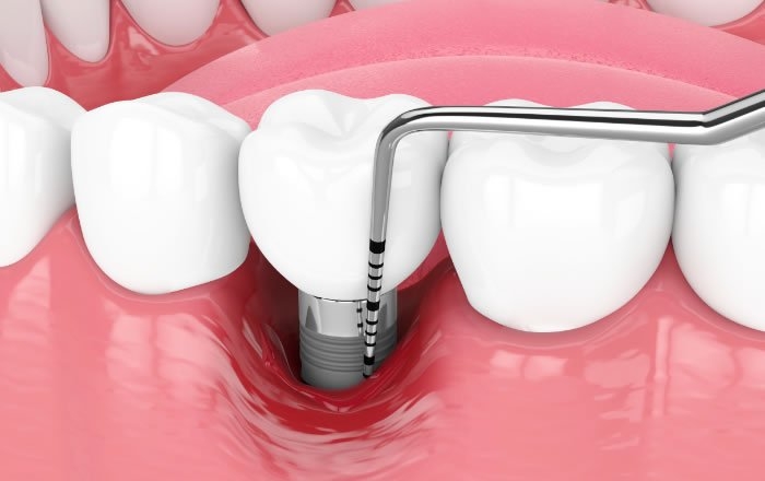 インプラントは虫歯にならない？