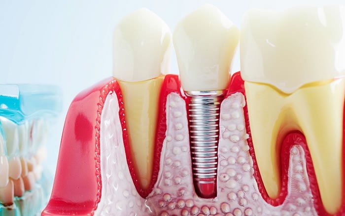 インプラント手術を受けるには検査が必要