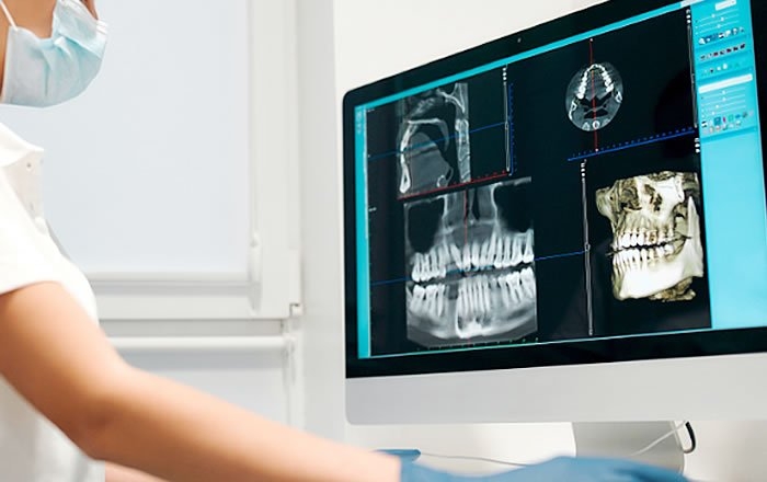 インプラント治療を受ける前に必要な検査とは？