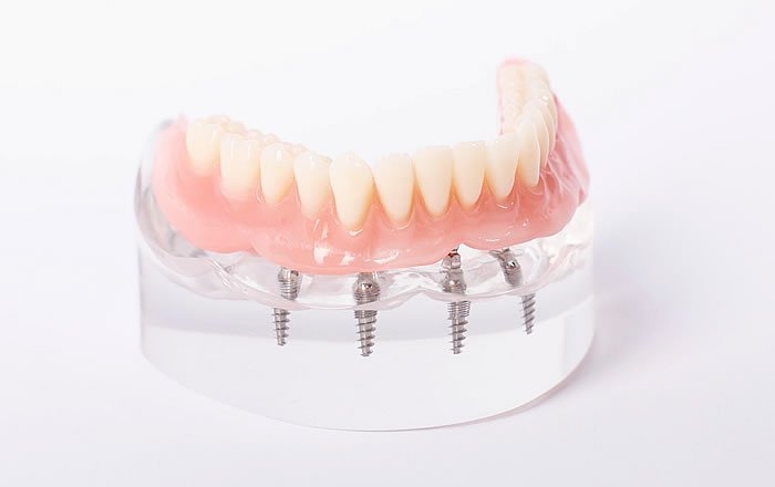 オールオン4(All-on-4®)のメリット:術後の痛みや腫れが少ない