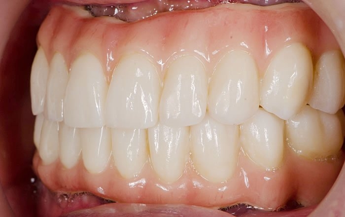 オールオン4(All-on-4®)とは