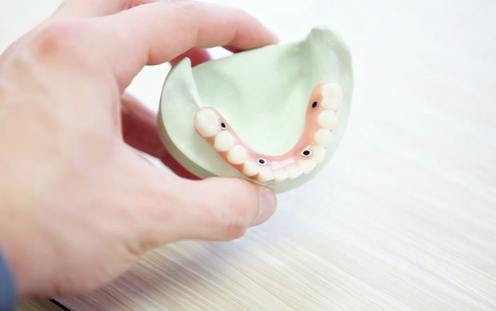 オールオン4(All-on-4®)のメリット:治療費を抑えられる