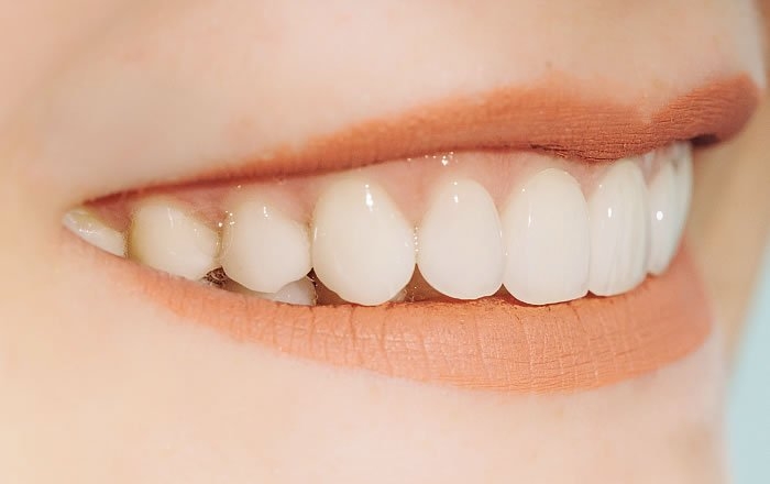 オールオン4(All-on-4®)のメリット:仕上がりが美しく、自然