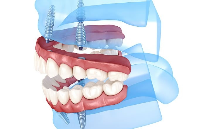 オールオン4(All-on-4®)のご相談もインプラントオフィス大通に