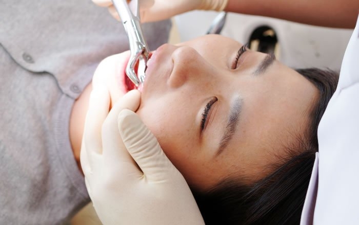 オールオン4(All-on-4®)のデメリット:残っている歯の抜歯が必要