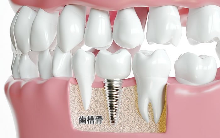インプラント治療後に歯茎が下がる原因：歯槽骨の減少