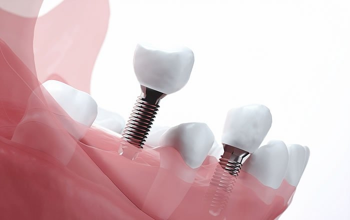 インプラント治療後に歯茎が下がる原因：インプラントの位置や太さ