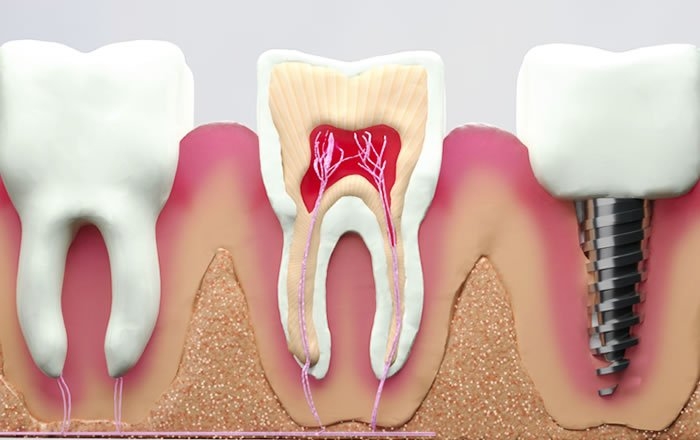 歯茎が下がる他の理由：歯周病