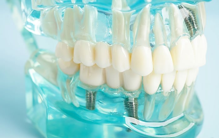 インプラント治療後の歯肉退縮を防ぐ方法：噛み合わせの調整