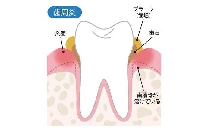 歯周炎（慢性歯周炎、進行性歯周炎）