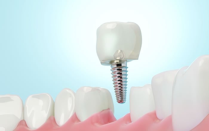 歯周病があるとインプラント治療が難しくなる理由：治癒が遅くなる